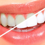 4 Teeth Whitening Myths Debunked: A Rendezvous with the Facts